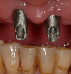 Cement and Screw Retained Implant Restorations